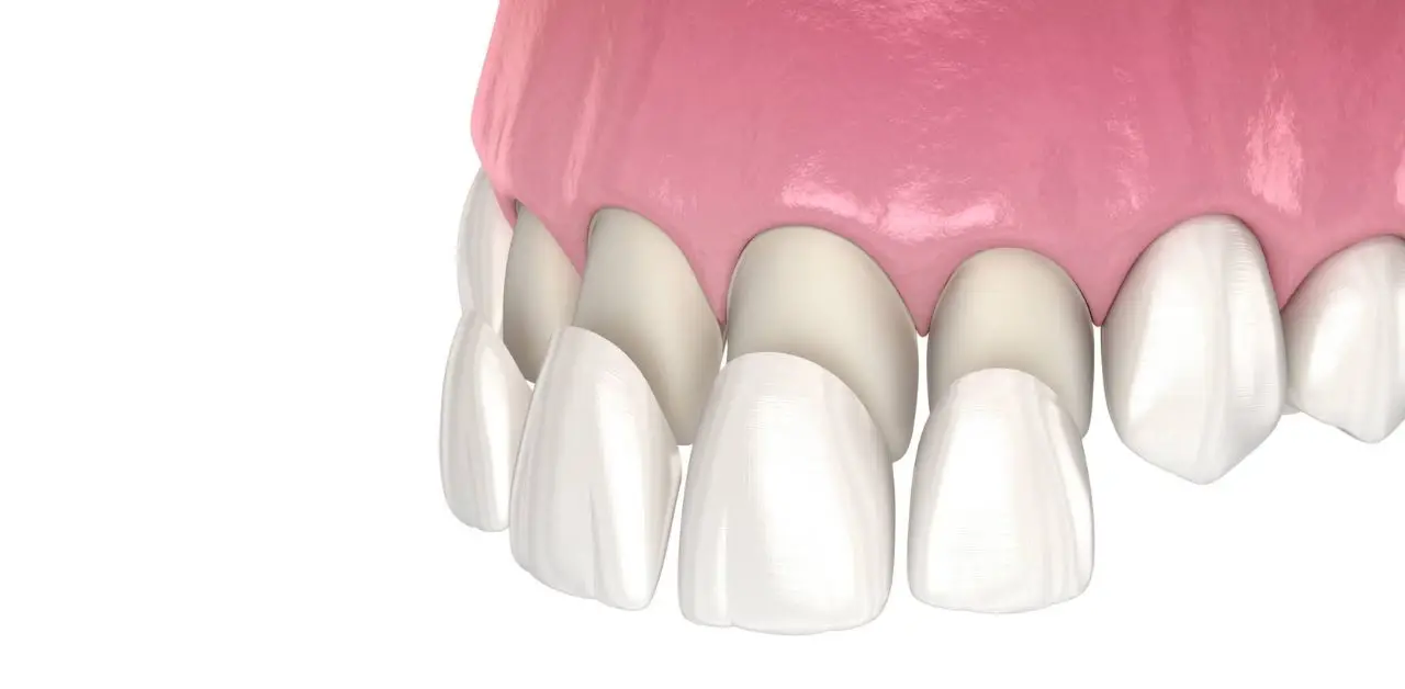 Bọc răng sứ ở đâu tốt TPHCM? Tiêu chí quan trọng cần biết