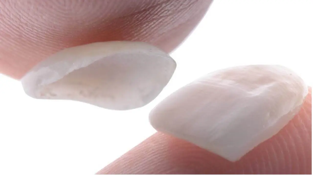 Veneer sứ 3D xu hướng thẩm mỹ hiện đại cho nụ cười đẳng cấp