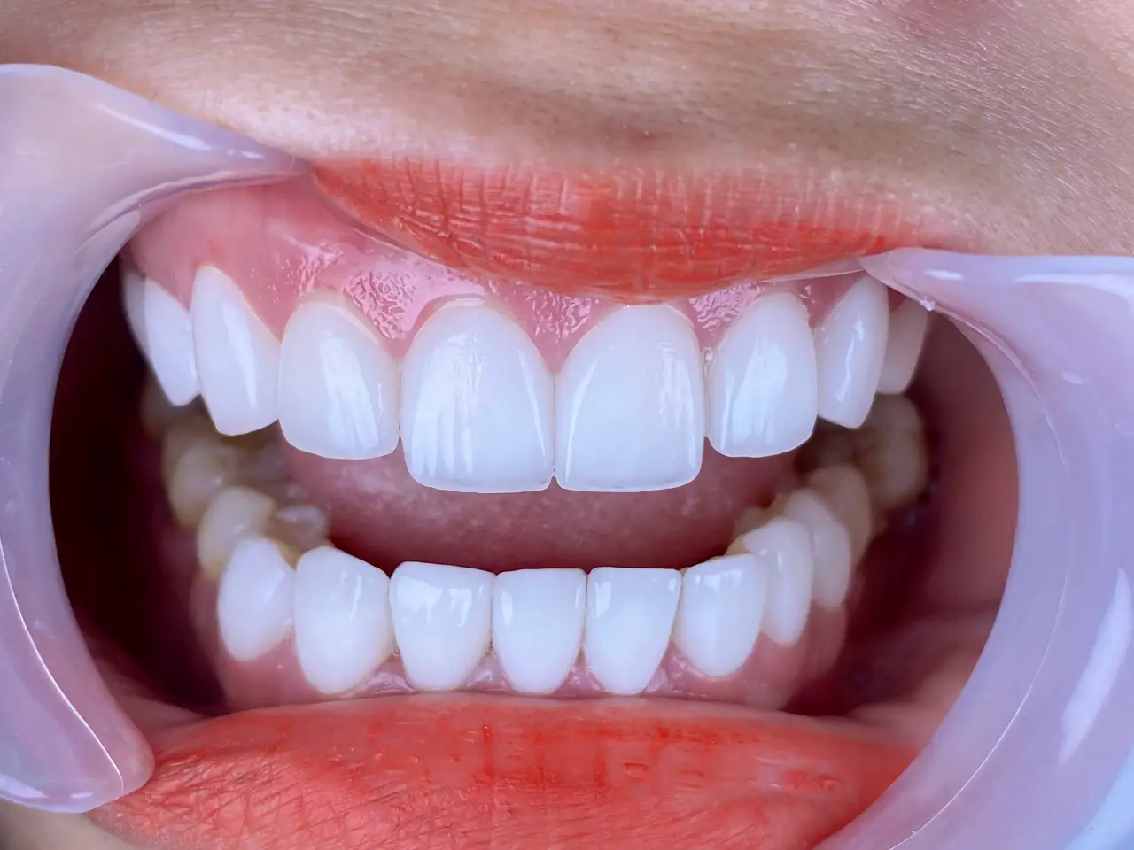 Veneer sứ TPHCM - Dán sứ veneer ở đâu đẹp TPHCM?