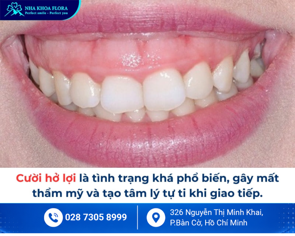 Cười hở lợi 1