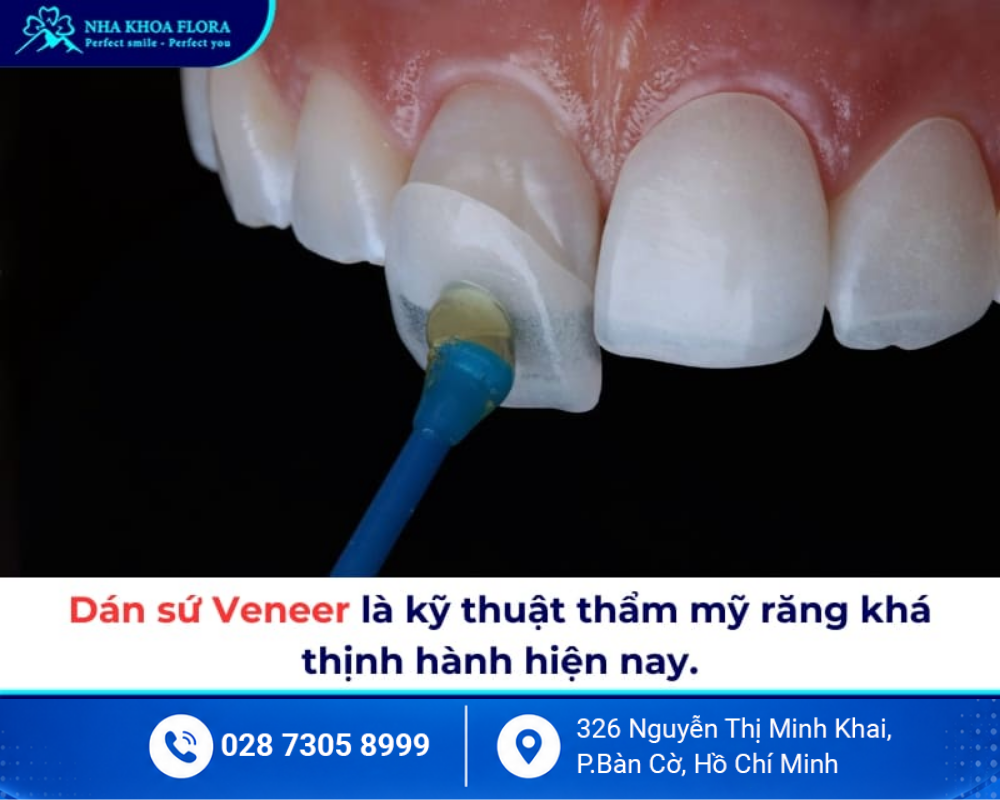 Dán sứ Veneer 1