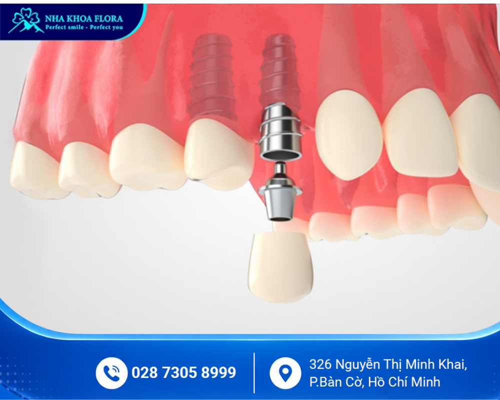 Trồng răng Implant 3