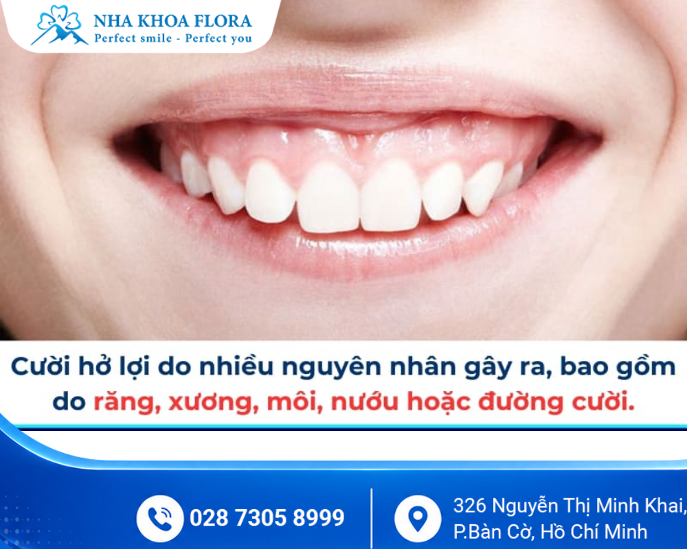 Cười hở lợi 2