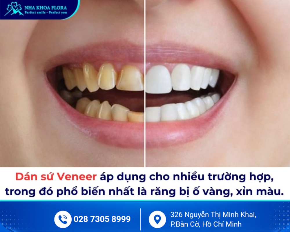 Dán sứ Veneer 3