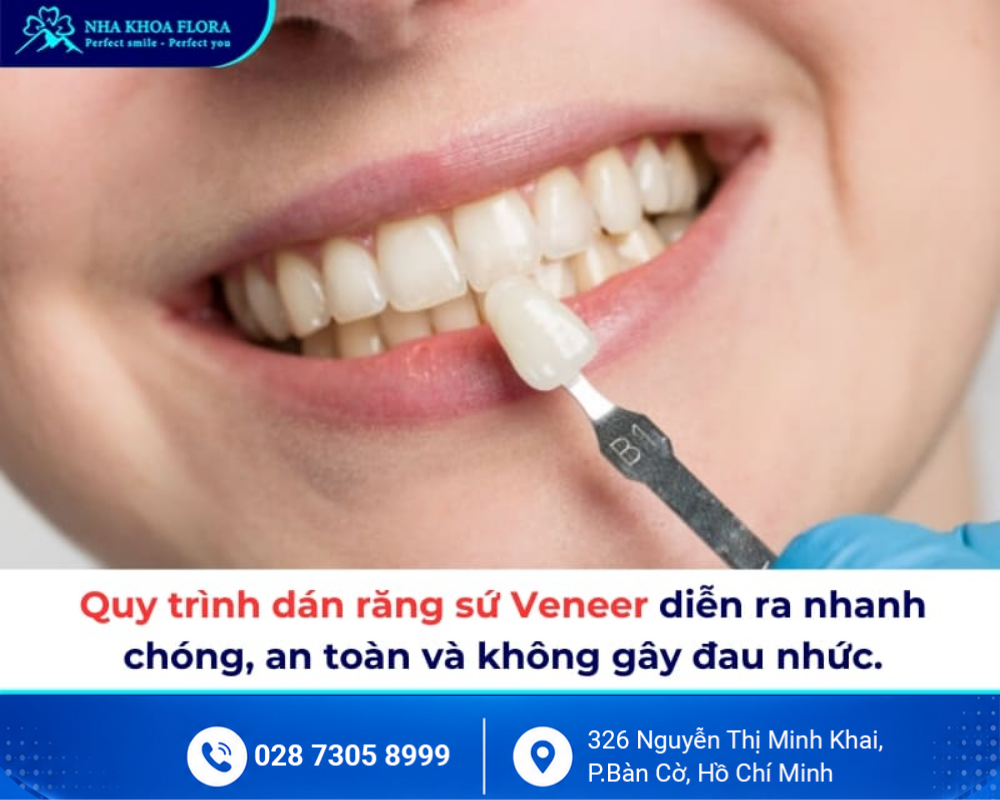 Dán sứ Veneer 4