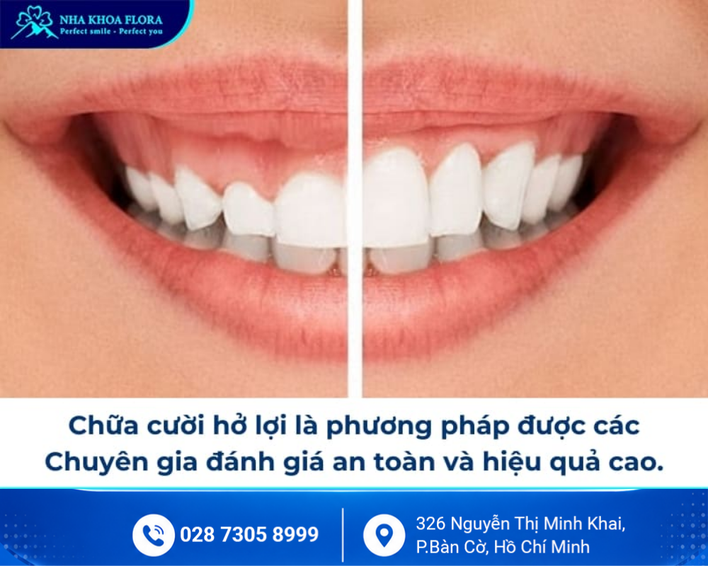 Cười hở lợi 4