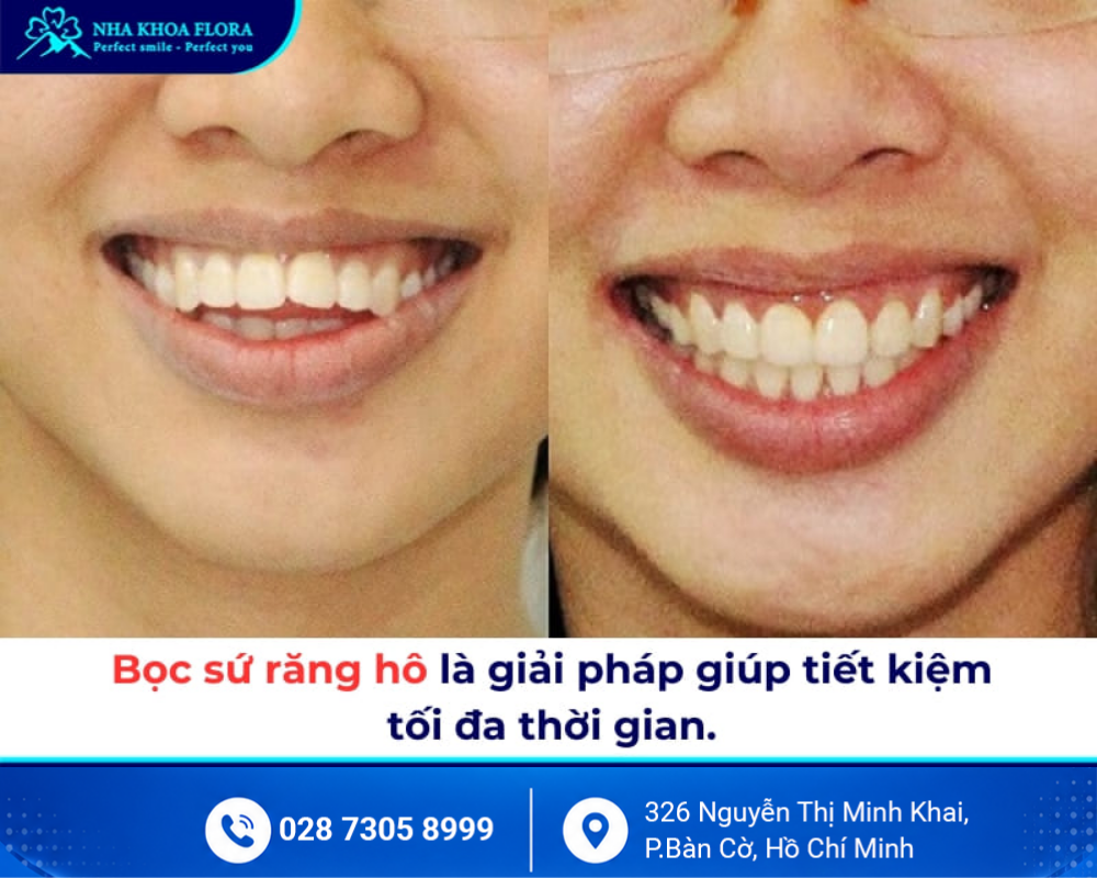 Bọc răng sứ thẩm mỹ 8